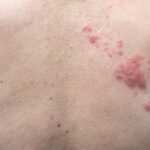 Jamur Kucing pada Manusia: Penyebab, Gejala, dan Cara Mengatasinya dengan Aman