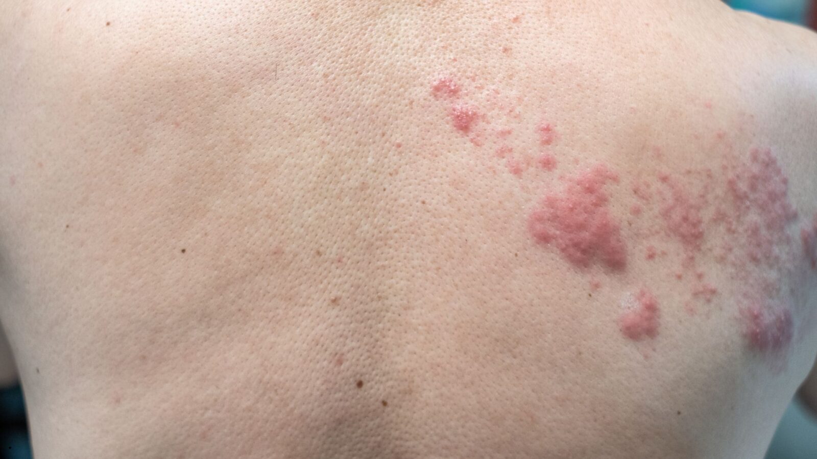 Jamur Kucing pada Manusia: Penyebab, Gejala, dan Cara Mengatasinya dengan Aman