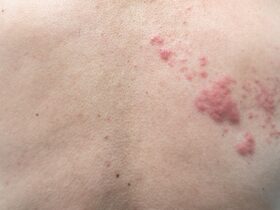 Jamur Kucing pada Manusia: Penyebab, Gejala, dan Cara Mengatasinya dengan Aman